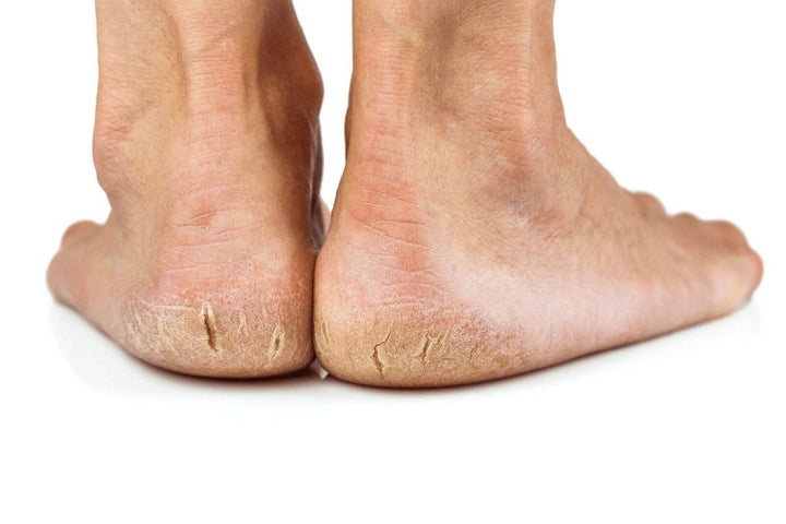 Dry, cracked feet needing intensive care by Nordic Care Foot Care Cream.