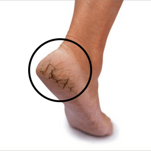 Cracked Heels - A Common Problem - Nordic Care